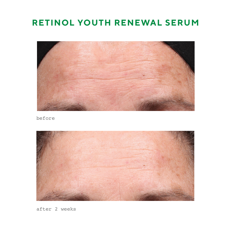 We have 1,500 samples to give away of the 🏆 #1 retinol product in the U.S. Click here to enter: bit.ly/MuradRetinolSe…. Here’s why our Retinol Youth Renewal Serum is a bestseller...
.
After just 2 weeks:
💚 93% saw a reduction in lines and wrinkles
💚 98% noticed smoother skin