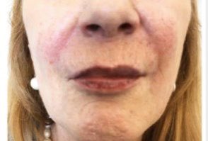 Surface_Beauty's tweet photo. We offer a range of dermal fillers at Surface Beauty.

These can be used to lift and fills areas which provide instant results like these.

#dermalfillers #edinburghcosmeticclinic #edinburghfillers

https://t.co/conxDDf5CT https://t.co/3gesSRzuXj