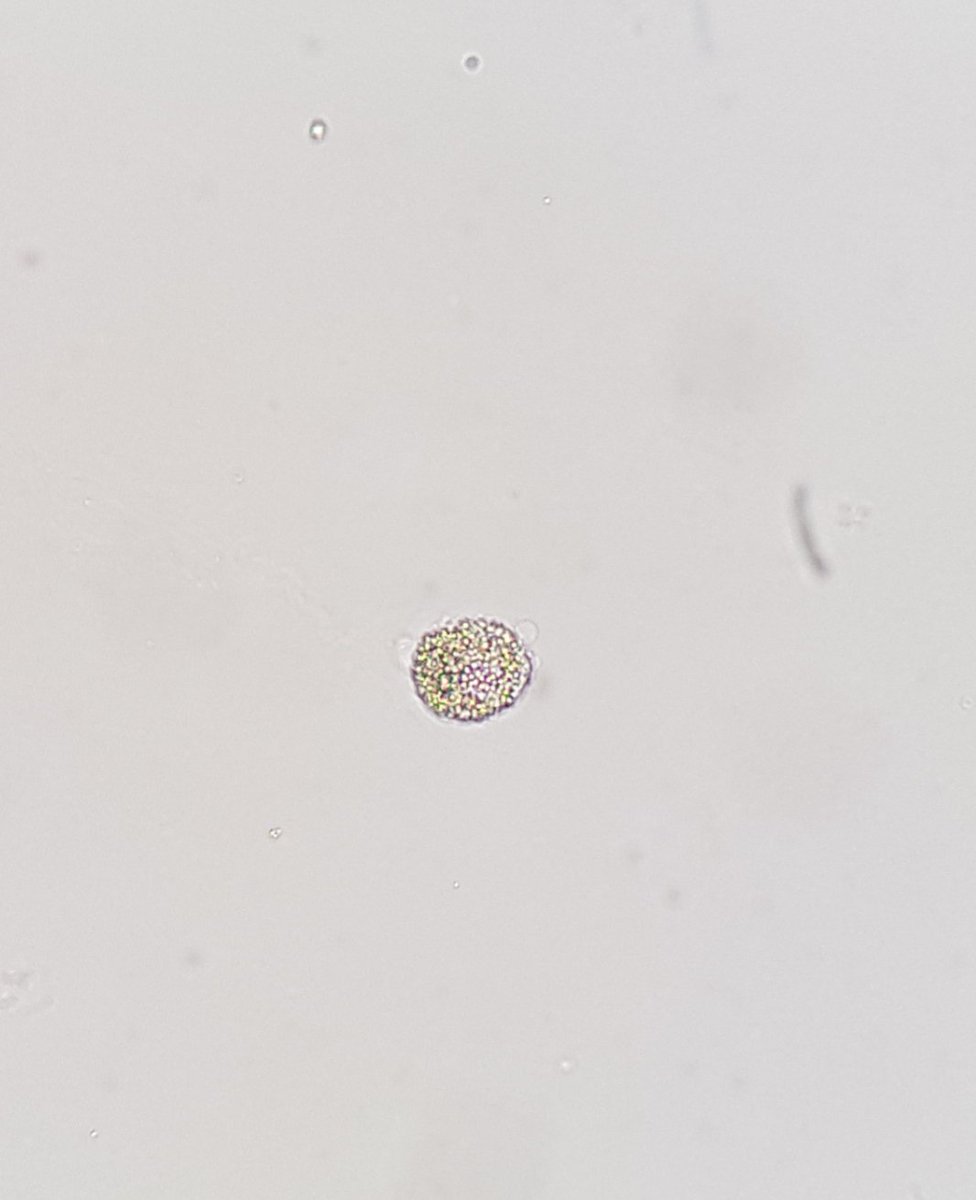 macrophage in urine sediment