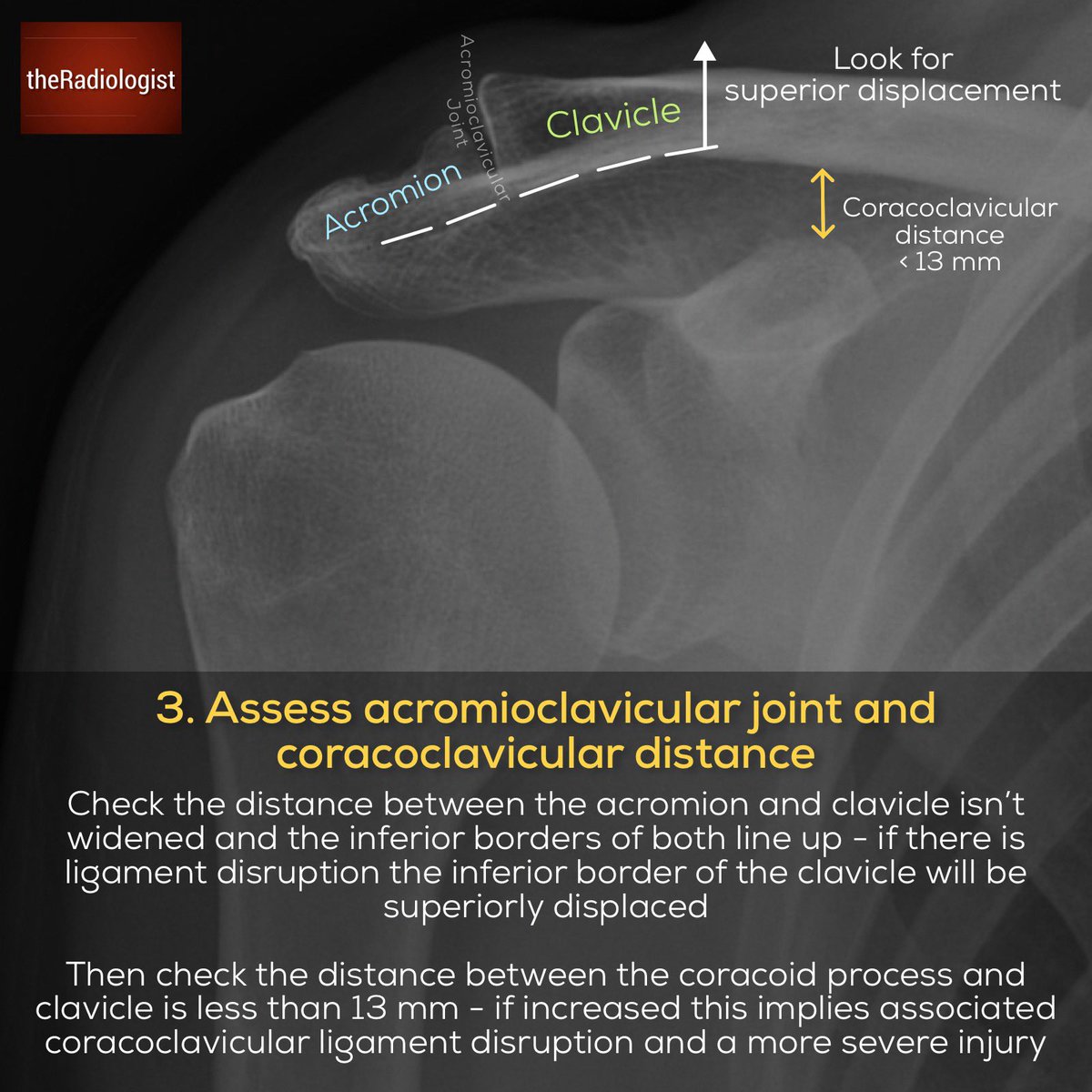 radiologistpage's tweet photo. AP shoulder X-Ray anatomy and basic strategy (1/2) https://t.co/3AcgOLiKj1