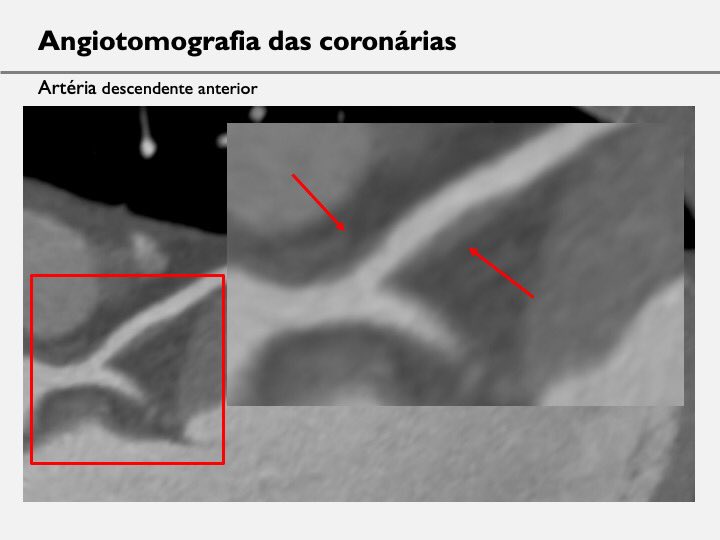 37Y sedentary and hx of sudden death (brother died w/ 42Y). Came for checkup. EKG normal, Echo normal, TT(max) normal. Assistant cardiology ordered a  #yesCCT. Patient went from 1% risk to a very high risk profile