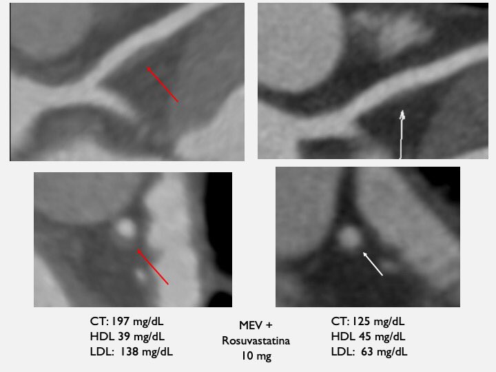 1.5 years later after lifestyle modification (physical activity), diet, rosuvastatin 10mg/day. That’s the beauty of cardiology  (case was courtesy of our great cardio-imager Dra Roberta Nolasco)