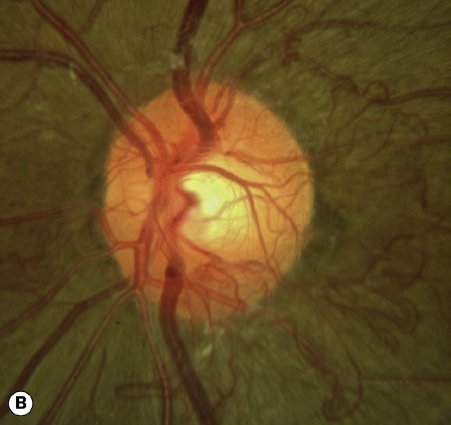 laboratoriosje's tweet photo. ***Clasificación de Retinopatía Diabética (GPC)

*No proliferativa
-Leve
Solo microaneurismas

-Moderada
Mas microaneurismas pero menos que la severa

-Severa
Hemorragias
Rosarios venosos
Anomalías Microvasculares 

*Proliferativa
Neovascularización
Hemorragia vítrea o preretinal https://t.co/xyTf1pfEfX