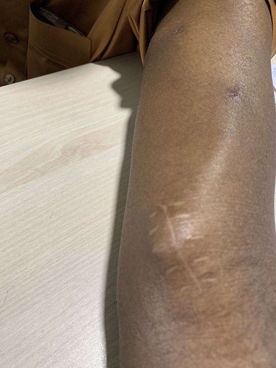 John Ngigi,OGW (@ngigi_dr) on Twitter photo An AVGraft is an option for long term vascular access in hemodialysis.it can be used 2 -3 weeks after creation but unlike an AV fistula is more likely to get an infection or a clot.its better than a catheter <a href="/joeruturi/">Dr Albert J Ruturi</a><a href="/MoturiMorara/">Moturi Morara</a> <a href="/andrewsuleh/">Dr Andrew Suleh MD</a> An AVGraft is an option for long term vascular access in hemodialysis.it can be used 2 -3 weeks after creation but unlike an AV fistula is more likely to get an infection or a clot.its better than a catheter <a href="/joeruturi/">Dr Albert J Ruturi</a><a href="/MoturiMorara/">Moturi Morara</a> <a href="/andrewsuleh/">Dr Andrew Suleh MD</a>