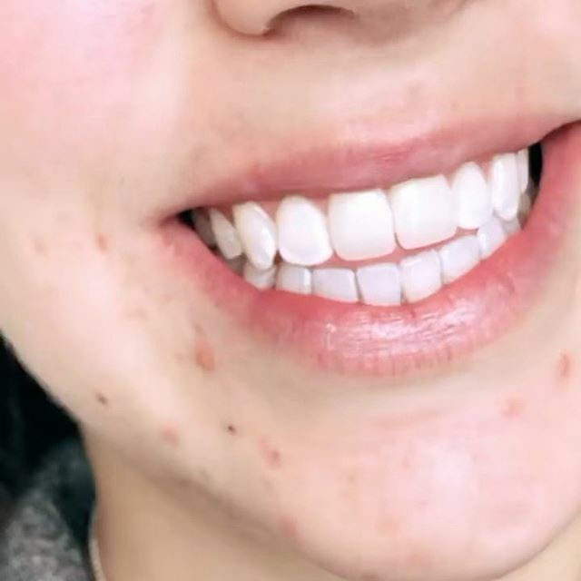 🦷✨ ift.tt/36ygkiE