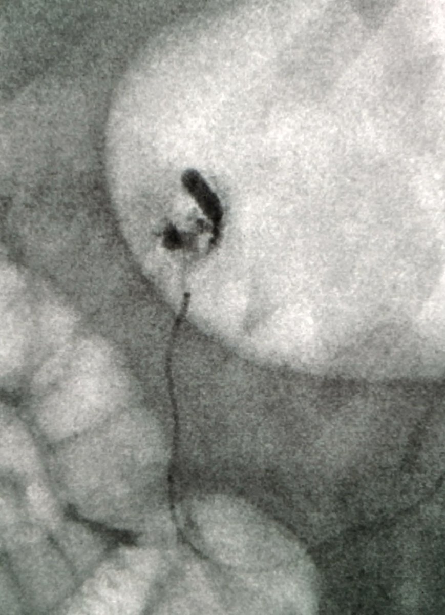Unstable pt GDA bleed on scope
Cool, I'll embo
Aorta's occluded
Cool, I'll go radial
Radial is 1 mm
Cool, I'll go ulnar
Celiac is occluded
Cool, I'll go transcollat via SMA 
Can't pass bleed to coil 
Cool, I'll glue

Stable, ready 4 d/c this week
#IRad is Cool 😎 <a href="/SIRspecialists/">Society of Interventional Radiology</a>