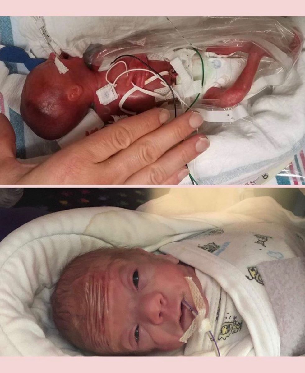 Brooklyn was born at 22 weeks and 5 days and weighed 1 pound and 1 ounce.  https://www.facebook.com/2217927698517409/posts/2421823884794455/?d=n