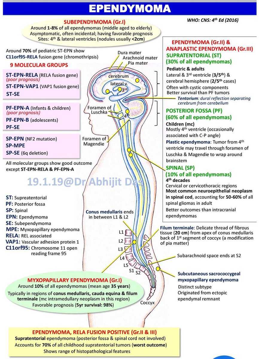 AbhijitSurgPath's tweet photo. #Ependymoma #MolecularSubtypes #BasicFactsForResidents #WHOCNS #MakeNeuropathEasy https://t.co/aKRzIYptr8