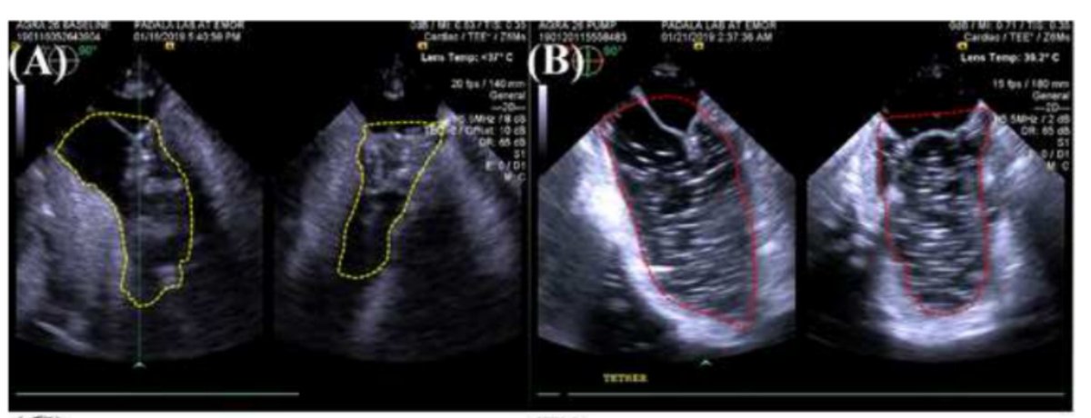 padalalab's tweet photo. Our new work on a model of functional mitral regurgitation to test TMVR technologies in #ASAIO #TMVR. Congratulations to Elorm Agra, 3rd year PhD student in our lab! https://t.co/3jVF2LwJQt
