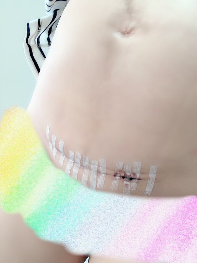 Twitter 上的 かさいあみ 性母 観て 切腹の跡 帝王切開の傷 名誉の負傷 まだいたい T Co Ueriaqibpc Twitter