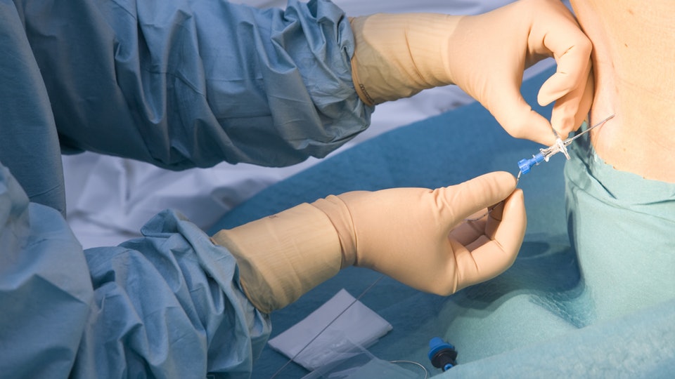 ASALifeline's tweet image. Obstetric anesthesiologist Dr. McCallum Hoyt discusses whether epidurals can cause chronic back pain in @romper. Read now: ow.ly/Lpr550xPAwS