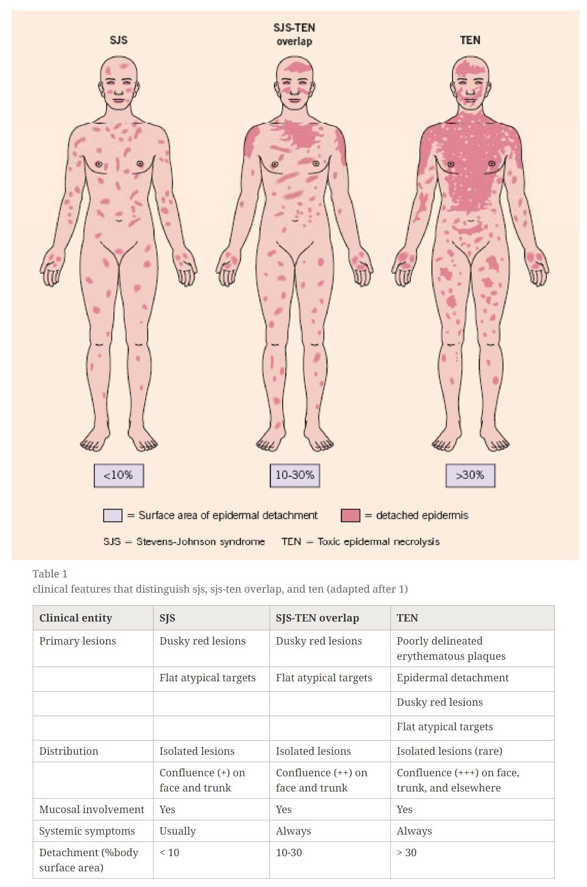 Sjs How Common Mild Steven Johnson Syndrome
