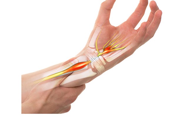 Carpal tunnel syndrome what it is and how to treatprevent it dlvr.it/RMd8Gy
