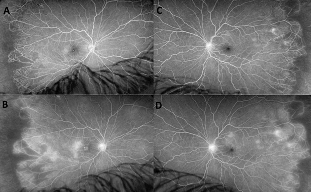 JournalGenetics's tweet photo. Coats Plus Syndrome and Mutation of the TERT Gene: A Case Report
Read More: https://t.co/sHYyXleWT5
#tertgene #gene #mutation #coatsplussyndrome #Genetics  
@AudreyAuregan @RaphaelBorie https://t.co/rnqyXl8Lmg