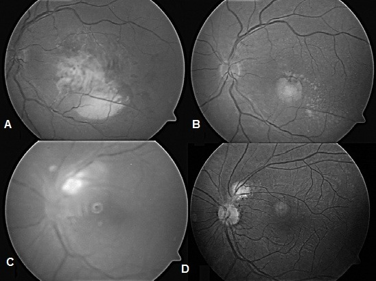 Atypical Herpetic Viral Posterior Uveitis: Non-necrotising Retinitis and Focal Retinitis
Read More: infectiologyjournal.com/articles/atypi…
#retinitis #Posteriorviraluveitis #retinalnecrosis