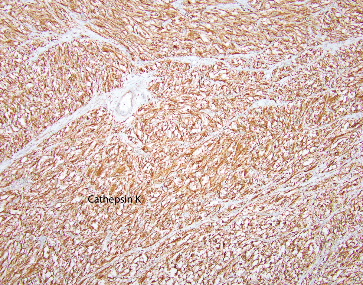 Check out this cool cutaneous PEComa! From the American Registry of Pathology, home of the AFIP Fascicles. arppress.org