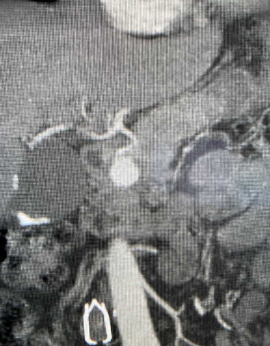 t_intheleadcoat's tweet photo. #GDA #aneurysm / #pseudoaneursym with unfavorable #celiactrunk anatomy, treated with #buddywire technique to gain access to common #hepatic artery.#Ruby and #Cx #coils to #embolize. #irad @SIRspecialists @SIR_ECS @SIRRFS @GESTSymposium @PenVascular @JVIRmedia @EVToday #TwittIR https://t.co/VDP9aDNUXr