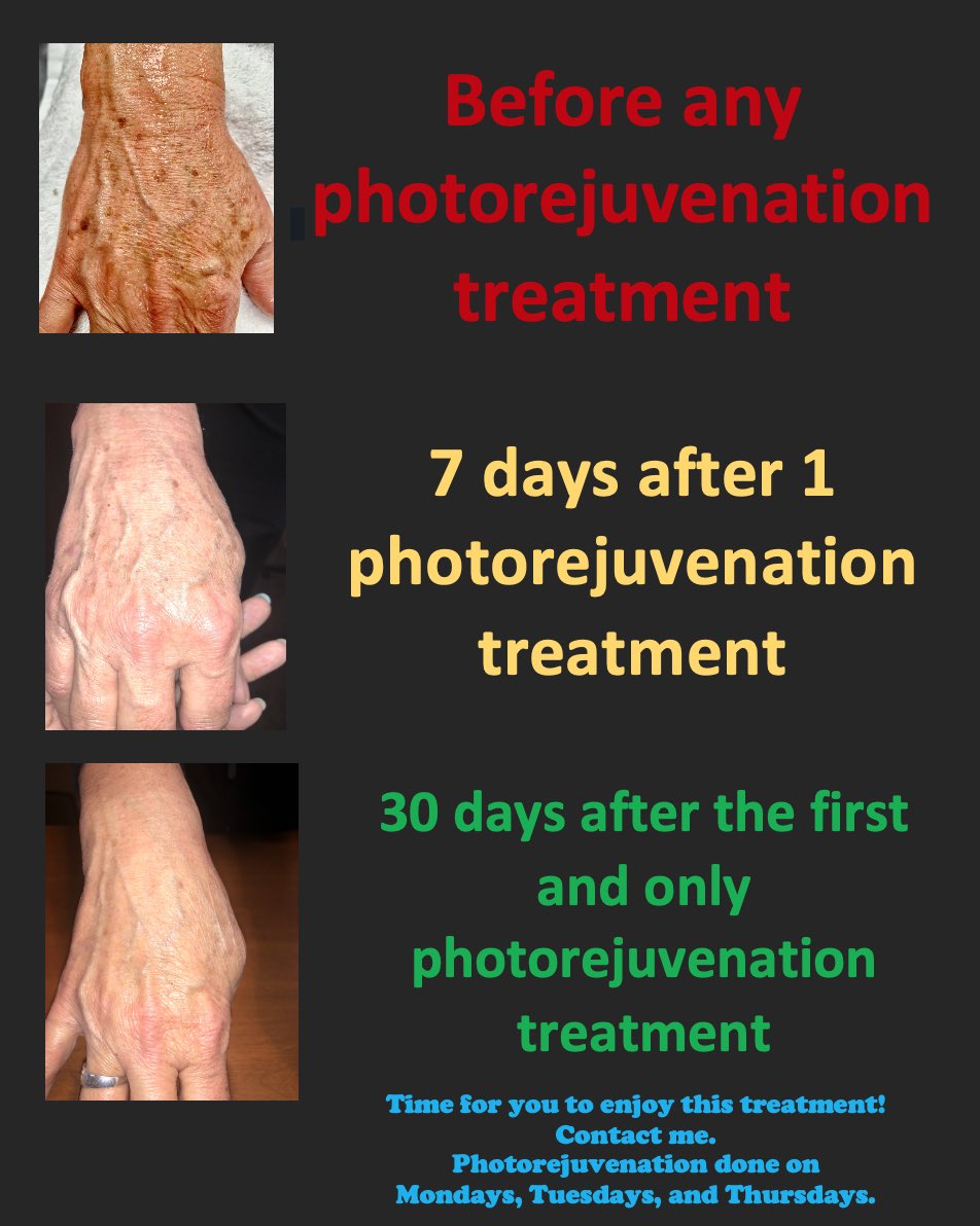 Wow! Look what one treatment can do! #Photorejuvenation #IPL #hyperpigmentation #sundamage #skincare #skin #AntiAging #medspa #medicalaesthetics #skintreatment  #eliteservice #loveyourskin #skintherapy #esthetician