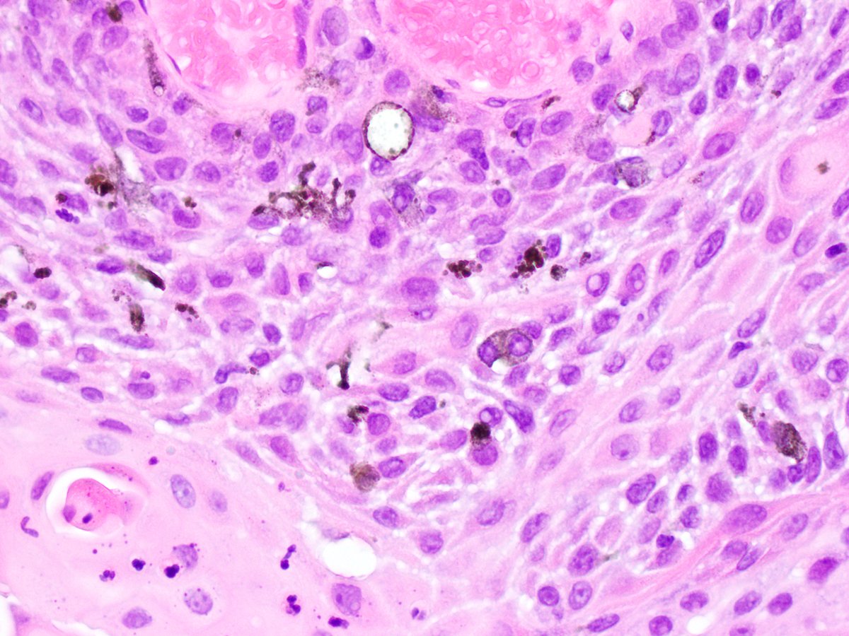 NeuroEyepath's tweet photo. Another clinically and microscopically pigmented ocular surface lesion which is not melanoma - in this case conjunctival squamous cell carcinoma in situ. #eyepath https://t.co/6doEwsHhTJ