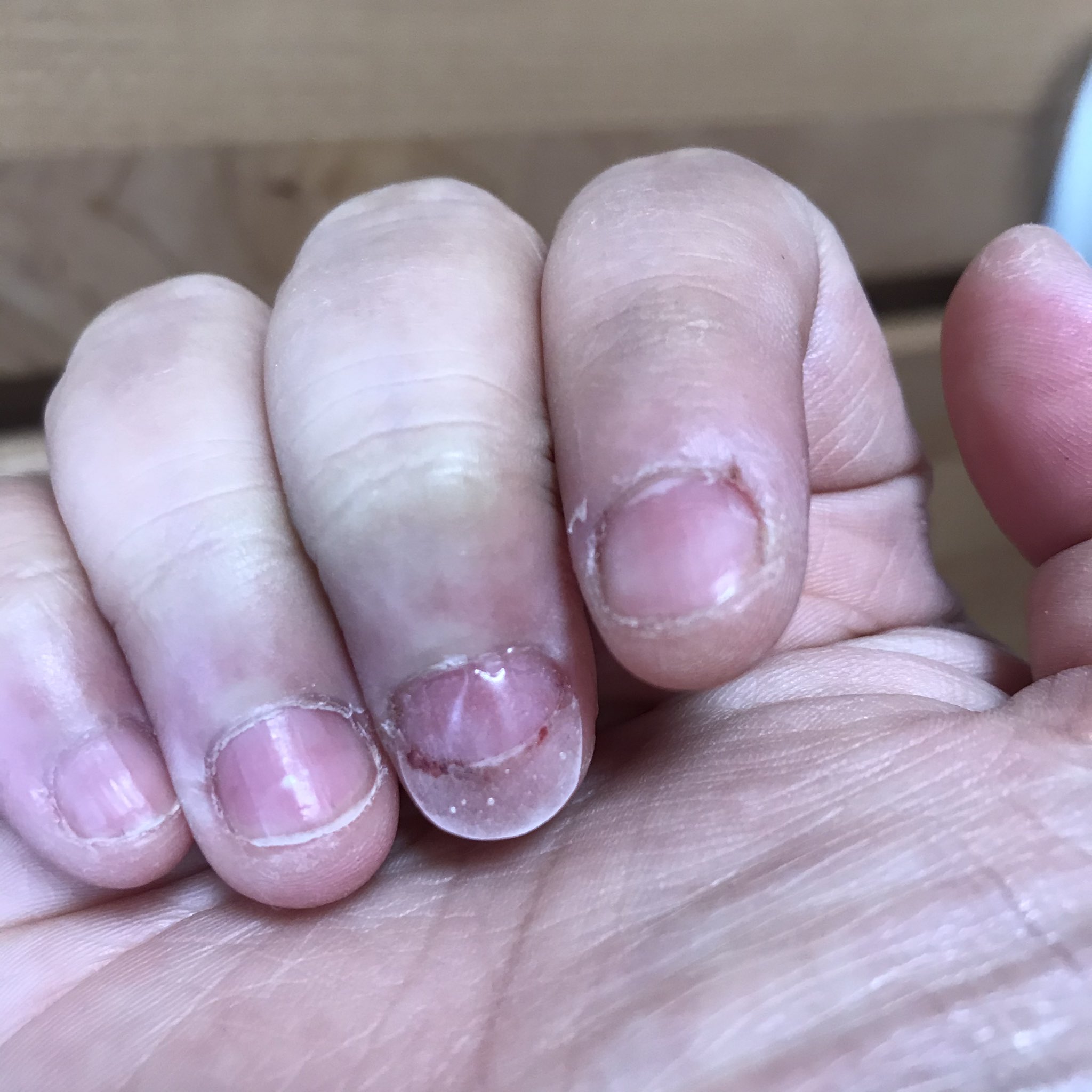 Mai リトド 自爪の長さがやばかったのがわかる方はこっち 少しグロいかも あとホント全体的に爪薄いし人差し指もよく深爪 流血餌食になるので ネイルとか好きなネイルチップ作って爪剥かないようにしていこうと思います T Co 9wwnxefwjm