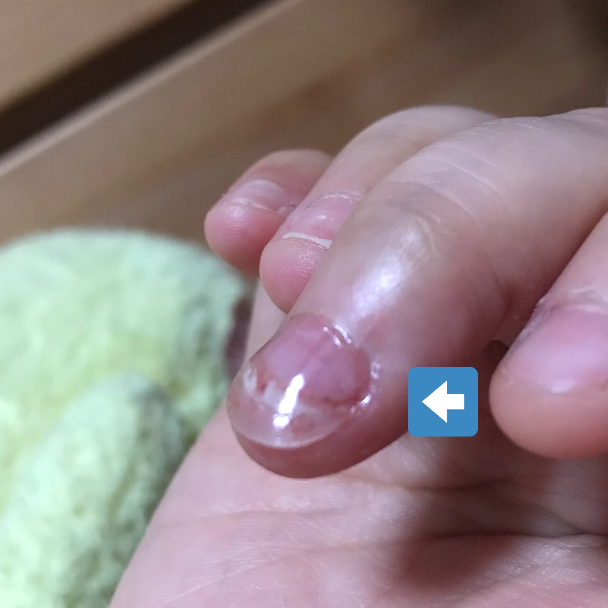 Twitter 上的 Mai リトド よく爪を剥く癖があるのだけど ここ半年くらいとても悪化してやっと伸びてきたのに気づいたら血まみれ深爪 剥ぐに近い だったので予防を見てたらジェルネイルがいいというのをみたので 家にあるuvレジンでやっつけ爪補強 ここまで
