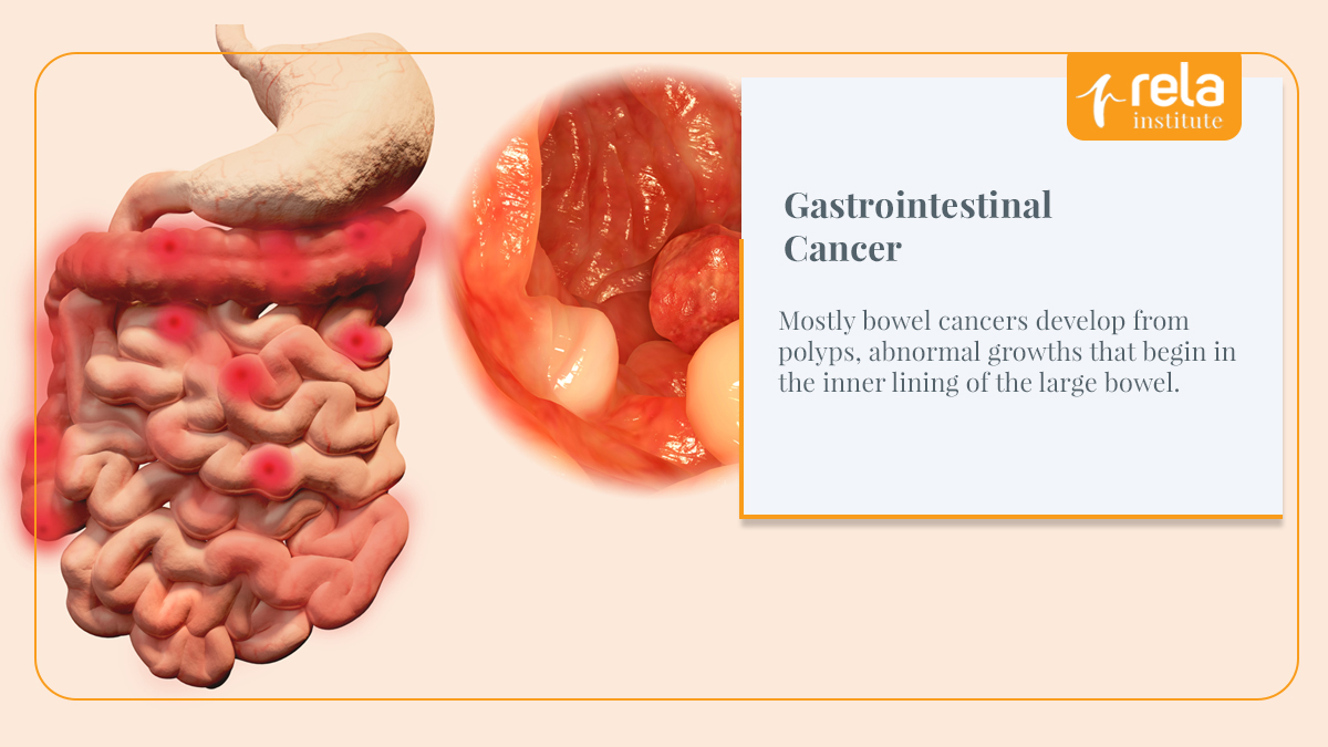 Rela_Institute's tweet photo. Mostly #bowelcancers develop from #polyps, abnormal growths that begin in the inner lining of the #largebowel
https://t.co/fPm7xrxOxG
+91 9384681770
#GIcancertreatmentinIndia #bowelcancerspecialistinchennai #topdoctorsfortreatmentofgastrointestinalcancers #relainstitute #RIMC https://t.co/iJVq6F2MM6