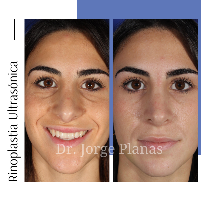 drjorgeplanas's tweet photo. Rinoplastia Ultrasónica corrigiendo el dorso nasal y punta caída.

⌚ Intervención de 1 hora
😴 Anestesia local o general
🏥 Hospitalización de 4h
🌟 Resultados en 1 semana
📩 Consúltame tu caso: secdirmed@clinicplanas.com  

Sígueme en Instagram ➡️ https://t.co/sBdFwFJf3O https://t.co/5DcrvmxVe7
