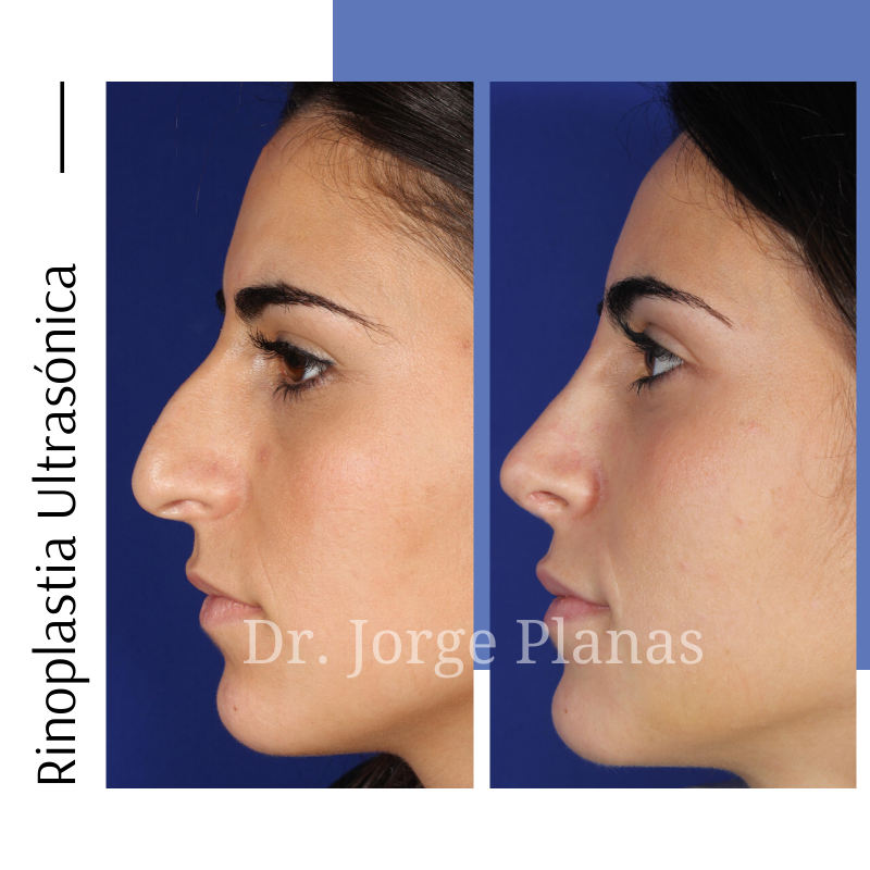 drjorgeplanas's tweet photo. Rinoplastia Ultrasónica corrigiendo el dorso nasal y punta caída.

⌚ Intervención de 1 hora
😴 Anestesia local o general
🏥 Hospitalización de 4h
🌟 Resultados en 1 semana
📩 Consúltame tu caso: secdirmed@clinicplanas.com  

Sígueme en Instagram ➡️ https://t.co/sBdFwFJf3O https://t.co/5DcrvmxVe7