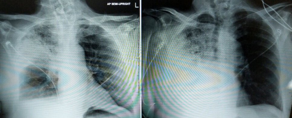 DrM_ISeeYou's tweet photo. Well appearing RUL PNA blows up 10 hours later and I’m draining pus from a chest and cannulating orifices. #Streptococcus keeps me humble. #fellowtwitter https://t.co/KniEwXdT1F