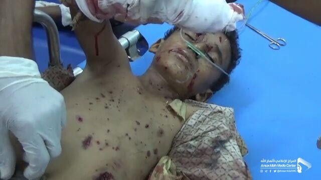 RealAnalysis10's tweet photo. #Al_Hodeidah: two children seriously injured,because of explosion Saudi led coalition of remnants bomb.
_children who were injured:
1_ Rahma Hassan Omar, is two years old
2_ Bassam Hassan Omar Ghabq, 10 years old
#yemen https://t.co/wNmSw3BL1h
