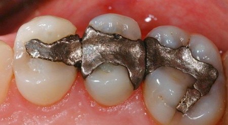 AndersFrihamn's tweet photo. Tandamalgam med kvicksilver fortfarande ett problem(?) https://t.co/SGNXJCJAmK https://t.co/NylQdwLojn