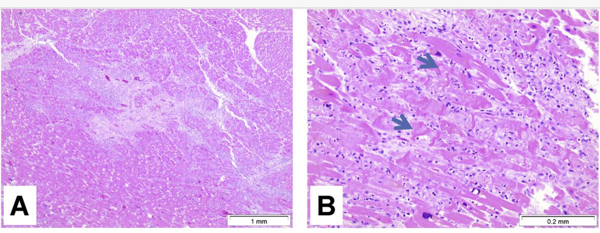 CVpathol's tweet photo. Acute fatal myocarditis after single dose of anti-pd-1 immunotherapy, autopsy findings: a case report

https://t.co/v3pCx0HcA2

#cardiacpath #cvpath https://t.co/Ojq4RV9itU
