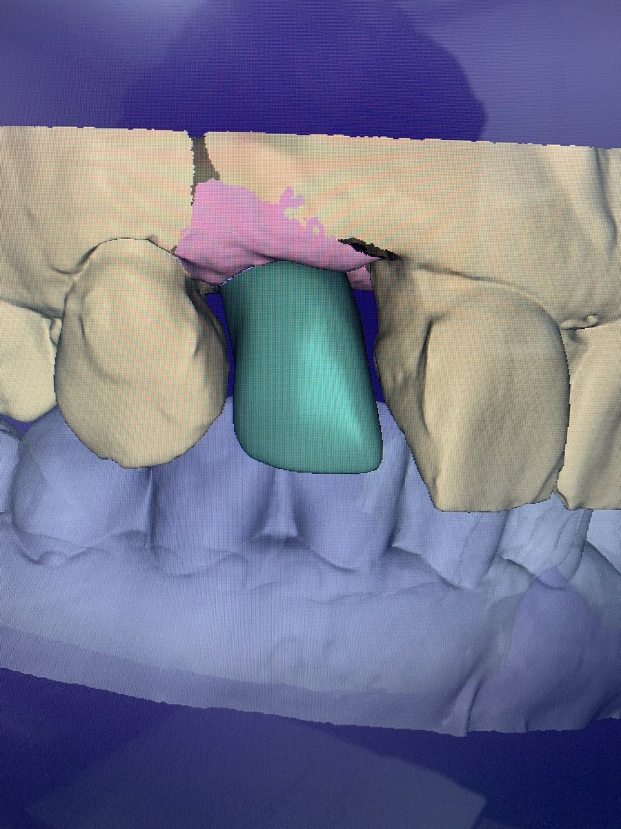 jpdentallab's tweet photo. #circonio #zirconio o #circonia Le llamemos como le llamemos seguiremos teniendo las excelentes propiedades que nos ofrece 🦷 #BadalonaDental 👉 https://t.co/NIUUxGCKNG ¿Y tú? ¿Ya trabajas con él? Aquí tenéis el proceso hasta la pieza en bruto! https://t.co/o9UzBaLt3W