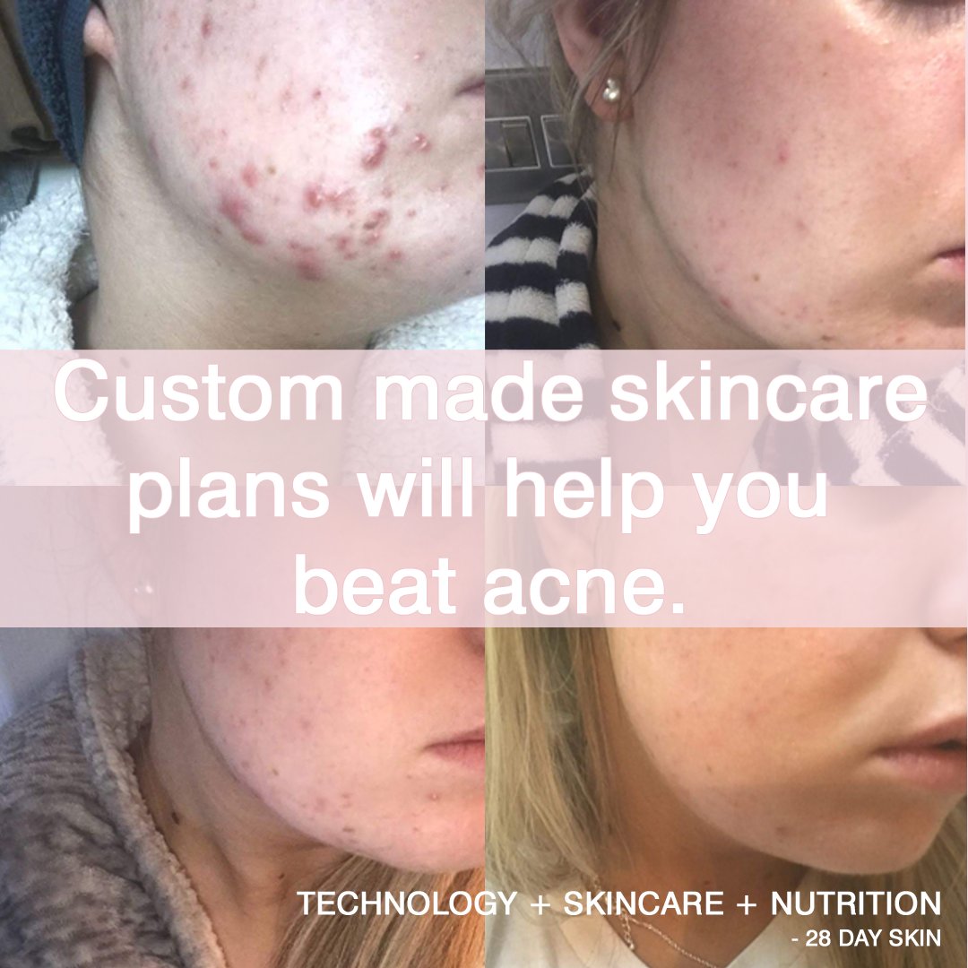 😇The secret to acne free skin = create a skin plan to tackle each part of the ACNE FORMATION CHAIN ⏩ IG <a href="/28dayskin/">Kevin Herbert</a> clinically proven to reduce acne by 40% in 4 wks 👍and completely in 12 wks 🙌 skincare+technology+nutrition+lifestyle | say #notobenzoyl ❌#notoisotretino🚫