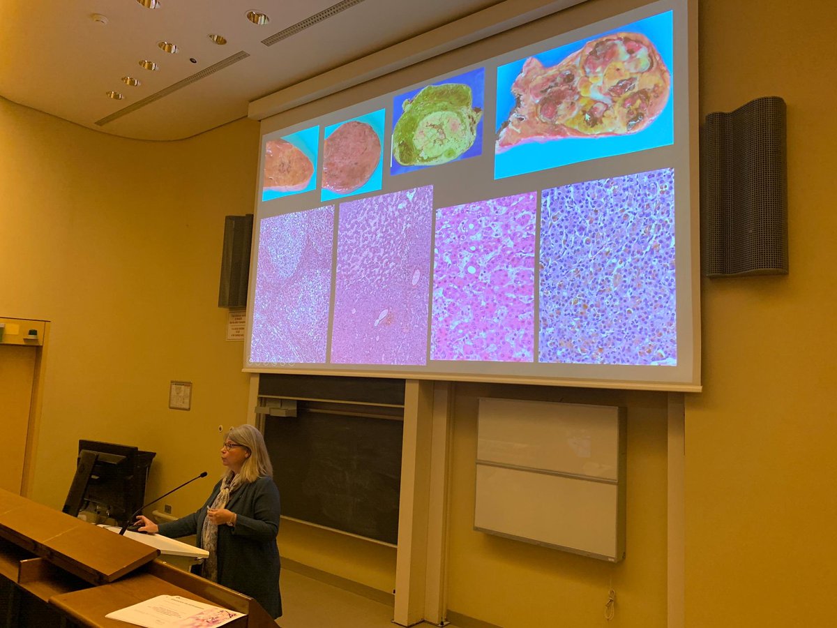 VisceralChuv's tweet photo. Tonight in @VisceralChuv’s #grandround we have the pleasure to host Prof. Christine Sempoux from @CHUVLausanne who shares her great experience on hepatocellular adenomas: multidisciplinary management is the key !! @ProfDemartines #GrandColloqueCHV https://t.co/B8kRZ7ACI6