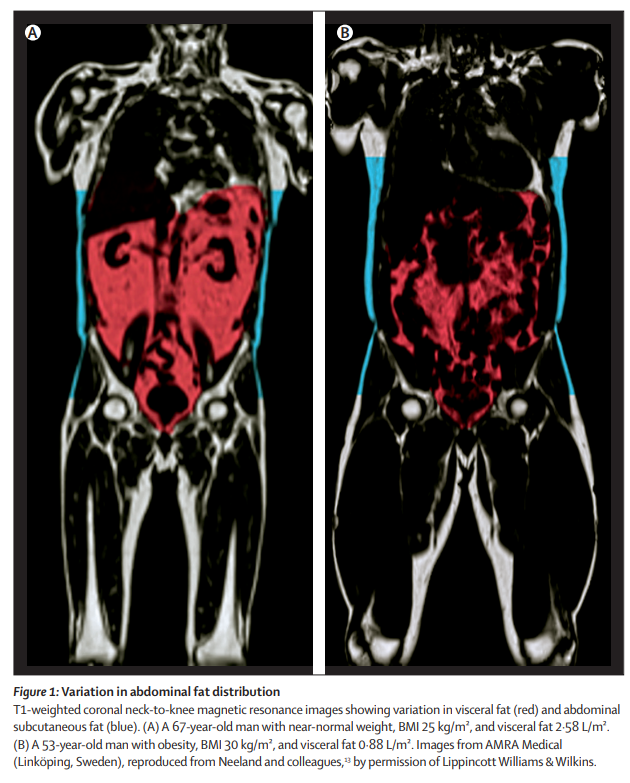 Mangan150's tweet photo. Visceral fat (in red), subcutaneous fat (blue). Man on the left is normal BMI, high visceral fat - skinny fat.

Man on right is "obese", low visceral fat. He clearly has lots more muscle, and perhaps that's why he has low visceral fat.

https://t.co/YXzWIls7EM https://t.co/UZN52nmL0a