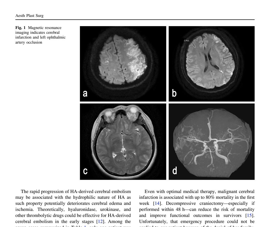 drsilvaplastica's tweet photo. Reporte de caso con infarto cerebral y oclusión de la arteria oftálmica después de inyección de ácido hialurónico en una rinomodelación https://t.co/wyK6HVowC6