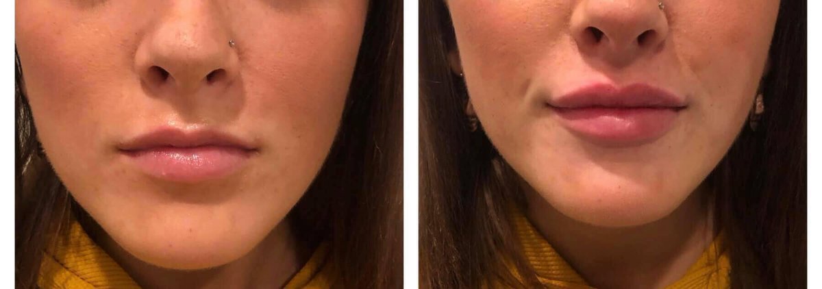 MedspaProfound's tweet photo. Deal Alert 🚨 $100 Gift Card for $75 for Juvederm fillers *gift cards have limited availability
Come in and get lips done by Melanie👇

Link provided:
https://t.co/S12LqmJUwH https://t.co/oJovgC2x1q