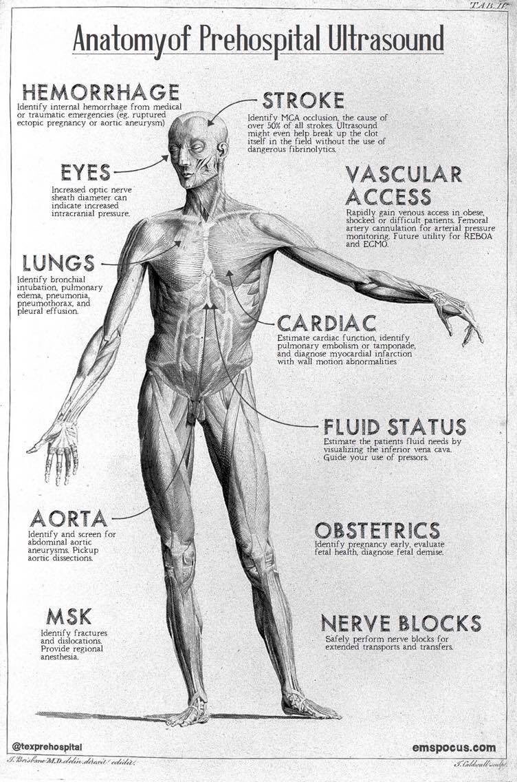 EMSPOCUS (@emspocus) on Twitter photo To help you see what can be done with #POCUS in #EMS, our Medical Director <a href="/texprehospital/">Jason Bowman</a> designed this beautiful graphic.
For your own class, call us at 1(800)-9910-3160 or slide into our DMs.
#FOAMed #FOAMus #Paramedic #FOAMems #ultrasound #emspocus To help you see what can be done with #POCUS in #EMS, our Medical Director <a href="/texprehospital/">Jason Bowman</a> designed this beautiful graphic.
For your own class, call us at 1(800)-9910-3160 or slide into our DMs.
#FOAMed #FOAMus #Paramedic #FOAMems #ultrasound #emspocus