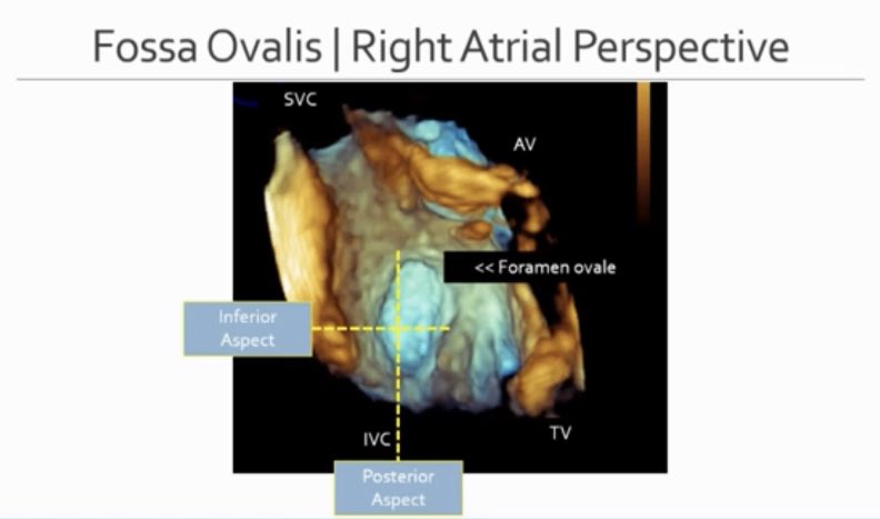 iamritu's tweet photo. Septal puncture for #mitraclip Location is 🔑
What is the best approach to get to lateral commissure 🆚 medial commissure?#ASEChoJC https://t.co/bsR02ELK39