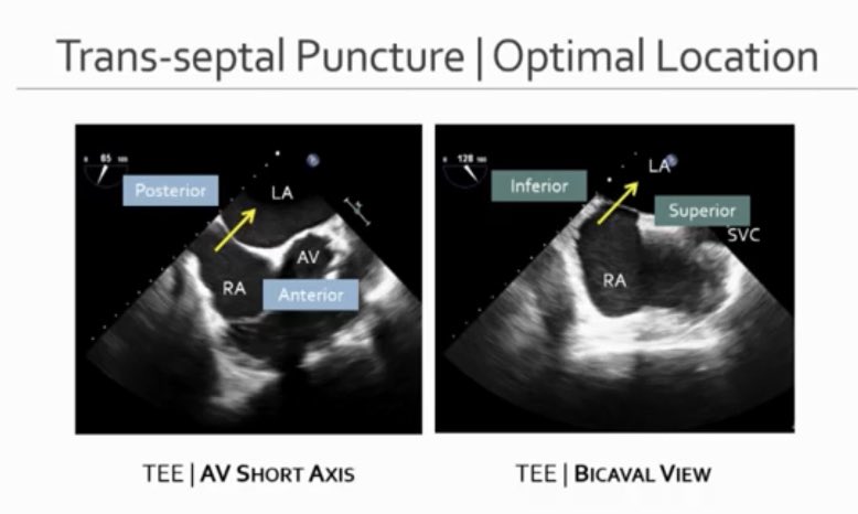 iamritu's tweet photo. Septal puncture for #mitraclip Location is 🔑
What is the best approach to get to lateral commissure 🆚 medial commissure?#ASEChoJC https://t.co/bsR02ELK39