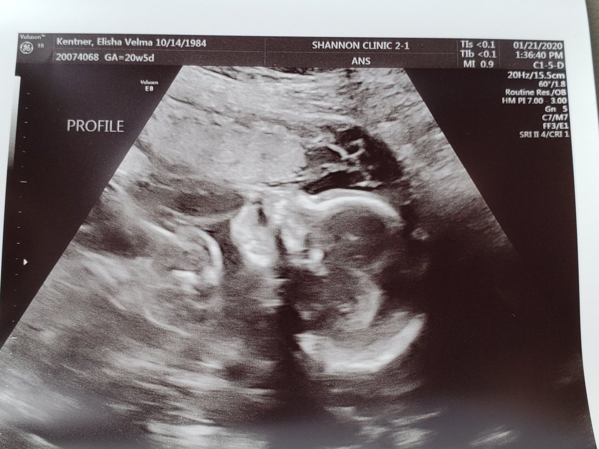 ElishaKentner's tweet photo. Almost 21 weeks.. can't wait to meet this sweet girl! She will be here before we know it! πππ₯° #soontobefamof4 #momofgirls #ivfmiracles #solucky https://t.co/WaJjdCsUcc