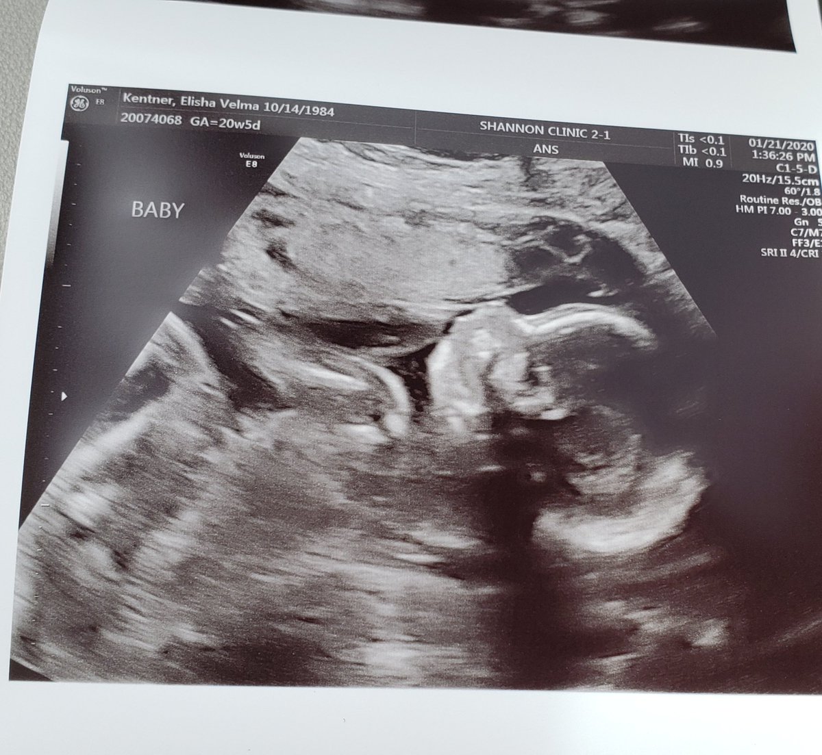 ElishaKentner's tweet photo. Almost 21 weeks.. can't wait to meet this sweet girl! She will be here before we know it! πππ₯° #soontobefamof4 #momofgirls #ivfmiracles #solucky https://t.co/WaJjdCsUcc