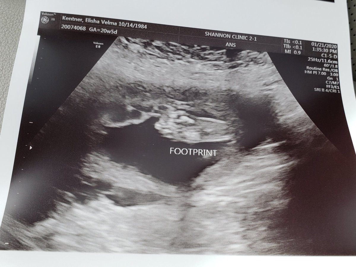 ElishaKentner's tweet photo. Almost 21 weeks.. can't wait to meet this sweet girl! She will be here before we know it! πππ₯° #soontobefamof4 #momofgirls #ivfmiracles #solucky https://t.co/WaJjdCsUcc