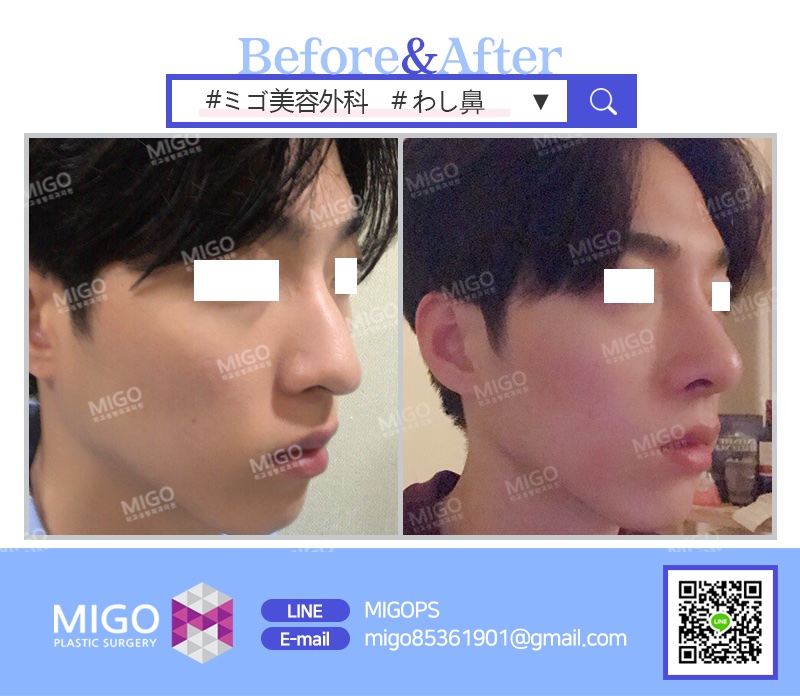 韓国整形 Migo美容外科 男性の鼻整形 ビフォーアフター わし鼻を矯正し 一直線に落ちる鼻ライン仕上げました お問い合わせ Line Migops Migo美容外科 韓国 韓国美容 韓国整形 韓国美容外科 美容整形 美容整形前後 鼻手術 鼻整形 わし鼻