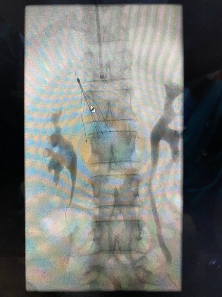 iRadHUKM's tweet photo. Filter in!  IVC filter for ovarian malignancy with lower limb DVT and pulmonary embolism. #IVCfilter #IRad #radiology #oncology #dvt #pe https://t.co/gf7pw2xJqS