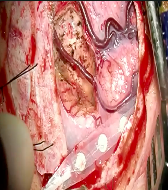 DrBaskaya's tweet photo. Recently published #Commentary about my video article Gross Total Resection of a Grade IV Astrocytoma Adjacent to the #Precentral Gyrus With #Nonawake Motor Mapping and Motor-Evoked Potential Monitoring
https://t.co/RDCTWSHQk8
@uw_neurosurgery @NeurosurgeryCNS #nsgy #opvid #ecase https://t.co/eZMsNVK8lR