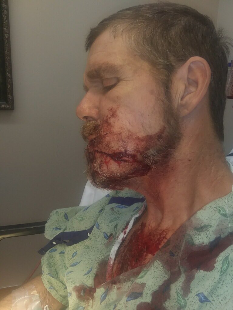 corey_jolly's tweet photo. Update on my pops. They sent him to hot springs for the surgery and it went well. They stopped the bleeding after he lost about 700 CC of blood. He is now home and on some good pain meds. Could have been way worse. Thanks for the prayers. https://t.co/tKXD63crpg