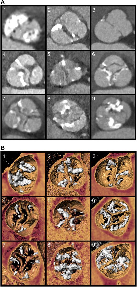 JACCJournals's tweet photo. Can 3D computer modelling help simulate paravalvular and pacemaker risk after #TAVR in bicuspid #vhdAS? Doctors from @StGeorgesUni present their first-in-human experience with patient-specific computer simulations of TAVR in valve morphology in #JACCINT. https://t.co/3hkvgu0sDT https://t.co/aVHw8NrhNd