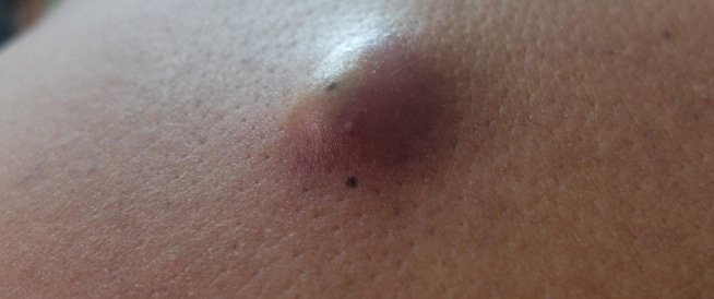 #معلومة
لا علاقة لظهور #الأكياس_الدهنية بتناول الأطعمة الغنية بالدهون أو بارتفاع نسبة الدهون في الدم ..

بعض أسباب ظهور الأكياس الدهنية :
🔹️العامل الوراثي .
🔹️الالتهابات المزمنة .
🔹️انسداد الغدد الدهنية .